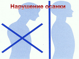 Нарушение осанки — первопричина эмоциональное состояние