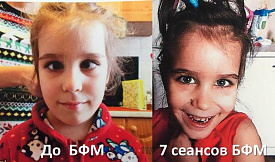Косоглазие