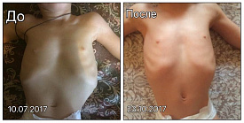 Рахит.и Деформация грудной клетки.