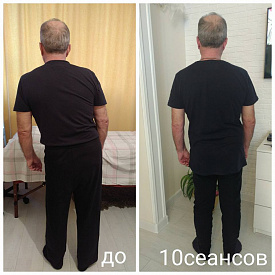 Радикулит