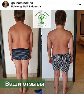 Аутизм