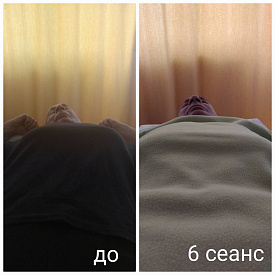 Сколиоз 5