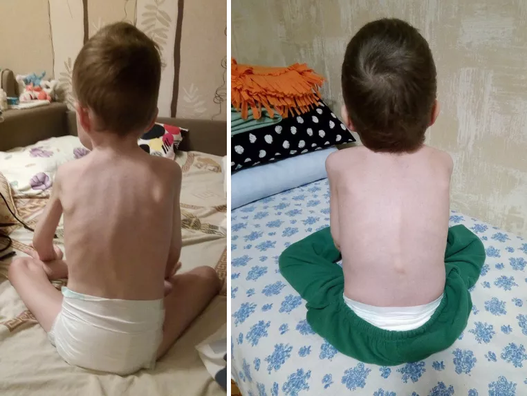 Сколиоз: признаки, степени и классификация