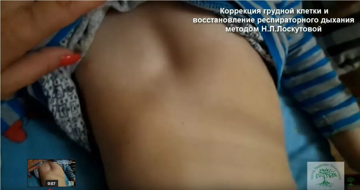 Деформация грудной клетки. Коррекция методом Лоскутовой